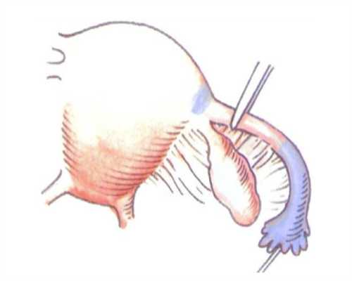 三代试管婴儿成功率有多高?三代试管婴儿活产率受哪些因素影响?