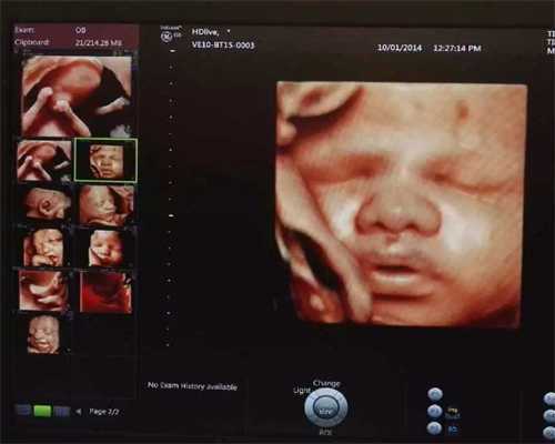 中山医院试管婴儿经历，上海中山医院做试管要多久？ 