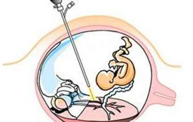 北大国际医院 羊水穿刺，2025北大医院羊水穿刺报告小程序上怎么查？ 