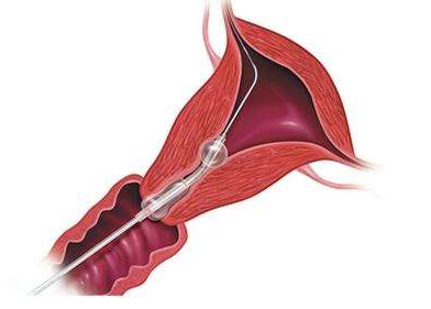 借卵试管合法吗，2025借卵做试管的费用清单，各项流程明细花费估算