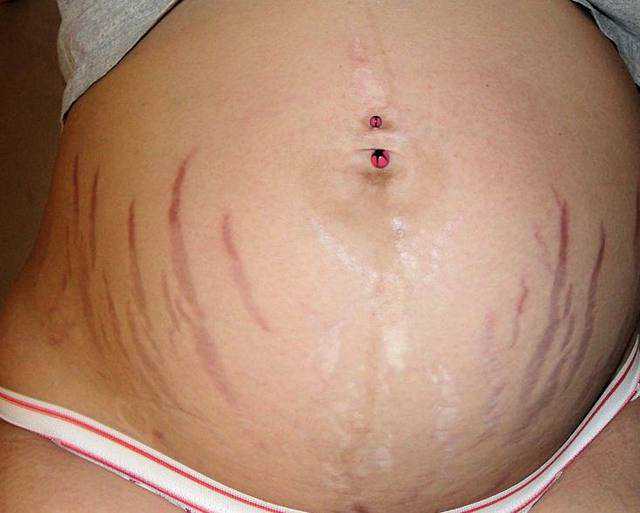 湿疹和热疹的区别图片一目了然妈妈切记病急乱投医，4张高清图片，告诉你湿疹与热疹到底有何区别